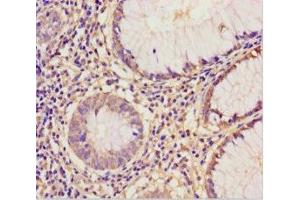 Immunohistochemistry of paraffin-embedded human colon cancer using ABIN7152221 at dilution of 1:100 (EIF6 抗体  (AA 1-245))