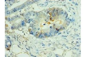 Immunohistochemistry of paraffin-embedded human colon cancer using ABIN7160825 at dilution of 1:100 (NLRP2 抗体  (AA 1-220))