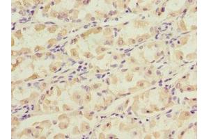 Immunohistochemistry of paraffin-embedded human gastric cancer using ABIN7149377 at dilution of 1:100