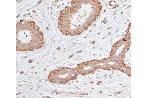 Immunohistochemistry of paraffin-embedded Human breast cancer using ABCC5 Polyclonal Antibody at dilution of 1:100 (40x lens). (ABCC5 抗体)