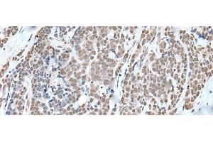Immunohistochemistry of paraffin-embedded Human thyroid cancer tissue using WTAP Polyclonal Antibody at dilution of 1:35(x200) (WTAP 抗体)