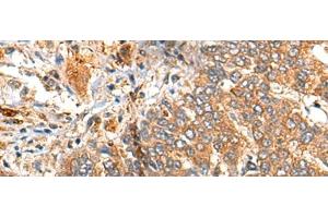 Immunohistochemistry of paraffin-embedded Human liver cancer tissue using MARK2 Polyclonal Antibody at dilution of 1:35(x200) (MARK2 抗体)