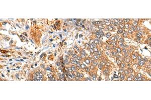 Immunohistochemistry of paraffin-embedded Human liver cancer tissue using MARK2 Polyclonal Antibody at dilution of 1:35(x200)