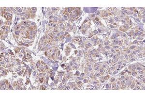 ABIN6278894 at 1/100 staining Human Melanoma tissue by IHC-P. (IL17C 抗体  (Internal Region))