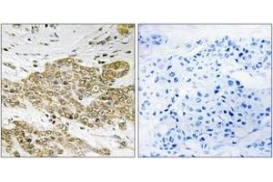 Immunohistochemistry analysis of paraffin-embedded human breast carcinoma, using p53 (Phospho-Ser6) Antibody.