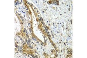 Immunohistochemistry of paraffin-embedded human liver cancer using CDC16 antibody  at dilution of 1:100 (40x lens). (CDC16 抗体  (AA 371-620))