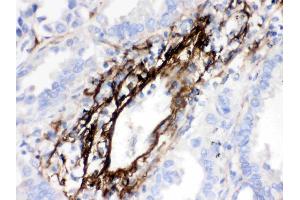 MGP was detected in paraffin-embedded sections of human lung cancer tissues using rabbit anti- MGP Antigen Affinity purified polyclonal antibody (Catalog # ) at 1 µg/mL. (MGP 抗体  (AA 20-96))