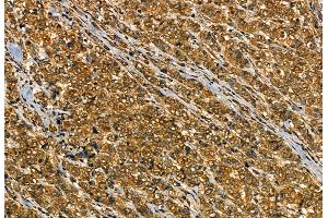 ABIN6259822 and ABIN6277769 at 1/100 staining Human breast cancer by IHC-P. (Aggrecan 抗体  (N-Term))