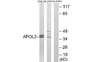 Immunohistochemistry analysis of paraffin-embedded human cervix carcinoma tissue using APOL2 antibody. (Apolipoprotein L 2 抗体)