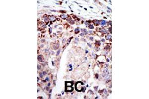 Formalin-fixed and paraffin-embedded human cancer tissue reacted with ATXN3 polyclonal antibody  , which was peroxidase-conjugated to the secondary antibody, followed by AEC staining. (Ataxin 3 抗体  (AA 29-59))