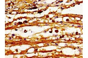 Immunohistochemistry of paraffin-embedded human melanoma using ABIN7147475 at dilution of 1:100 (CERS6 抗体  (AA 324-392))