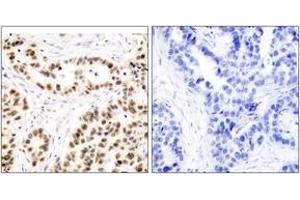 Immunohistochemistry analysis of paraffin-embedded human breast carcinoma tissue, using Elk1 (Ab-417) Antibody. (ELK1 抗体  (AA 379-428))