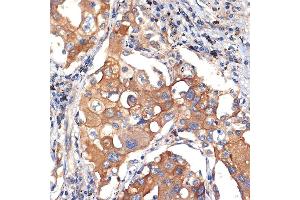 Immunohistochemistry of paraffin-embedded human lung cancer using eIF2C3 Rabbit mAb (ABIN7267039) at dilution of 1:100 (40x lens).