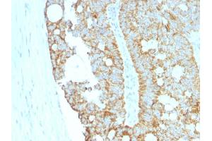 Formalin-fixed, paraffin-embedded human Colon Carcinoma stained with MAML2 Monoclonal Antibody (MAML2/1302). (MAML2 抗体)
