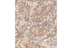 Immunohistochemical analysis of paraffin-embedded Human thyroid carcinoma tissue using B performed on the Leica® BOND RXm. (DLL3 抗体  (C-Term))