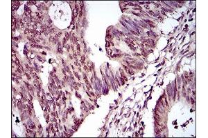 Immunohistochemical analysis of paraffin-embedded rectum cancer tissues using PIWIL4 mouse mAb with DAB staining. (PIWIL4 抗体  (AA 304-434))