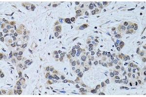 Immunohistochemistry of paraffin-embedded Human liver cancer using SIN3A Polyclonal Antibody at dilution of 1:100 (40x lens). (SIN3A 抗体)