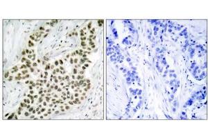 Immunohistochemical analysis of paraffin- embedded human breast carcinoma tissue using Histone H2A. (H2AFX 抗体)