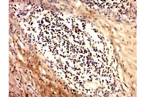 Paraformaldehyde-fixed, paraffin embedded human cervical carcinoma tissue, Antigen retrieval by boiling in sodium citrate buffer(pH6) for 15min, Block endogenous peroxidase by 3% hydrogen peroxide for 30 minutes, Blocking buffer (normal goat serum) at 37°C for 20min, Antibody incubation with Rabbit Anti-Ack1 (Tyr284) Polyclonal Antibody, Unconjugated  at 1:500 overnight at 4°C, followed by a conjugated secondary and DAB staining (TNK2 抗体  (pTyr284))