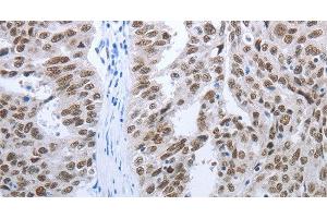 Immunohistochemistry of paraffin-embedded Human ovarian cancer tissue using RBMS1 Polyclonal Antibody at dilution 1:30 (RBMS1 抗体)