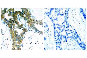 Immunohistochemical analysis of paraffin-embedded human breast carcinoma tissue, using PAK1/PAK2/PAK3 (Ab-423/402/421) antibody (E021169). (PAK1/2/3 抗体)