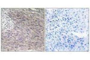 Immunohistochemistry analysis of paraffin-embedded human cervix carcinoma tissue using CHSS2 antibody. (CHPF 抗体)