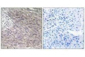 Immunohistochemistry analysis of paraffin-embedded human cervix carcinoma tissue using CHSS2 antibody. (CHPF 抗体)