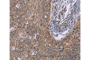 Immunohistochemistry of Human ovarian cancer using CSF2RB Polyclonal Antibody at dilution of 1:40 (CD131 抗体)