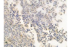 ABIN6259302 and ABIN6275409 at 1/100 staining human pituitary adenoma by IHC-P.