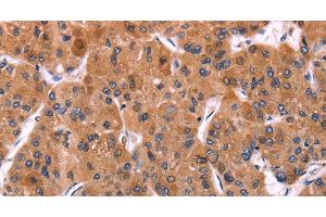 Immunohistochemistry of paraffin-embedded Human liver cancer using ERP29 Polyclonal Antibody at dilution of 1:40 (ERP29 抗体)