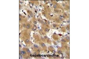 HPR Antibody (Center) (ABIN655063 and ABIN2844693) immunohistochemistry analysis in formalin fixed and paraffin embedded human hepatocarcinoma followed by peroxidase conjugation of the secondary antibody and DAB staining. (HPR 抗体  (AA 212-240))