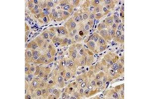 Immunohistochemical analysis of Tropomodulin-4 staining in human liver cancer formalin fixed paraffin embedded tissue section. (Tropomodulin 4 抗体)