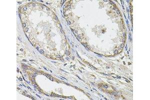Immunohistochemistry of paraffin-embedded Human prostate cancer using UBE2S Polyclonal Antibody at dilution of 1:100 (40x lens). (UBE2S 抗体)