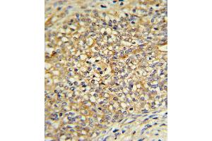 UDB17 Antibody (Center) (ABIN390399 and ABIN2840791) IHC analysis in formalin fixed and paraffin embedded human Prostate carcinoma followed by peroxidase conjugation of the secondary antibody and DAB staining. (UGT2B17 抗体  (AA 119-147))