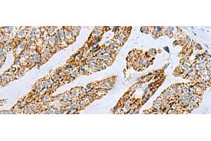 Immunohistochemistry of paraffin-embedded Human gastric cancer tissue using PYCR2 Polyclonal Antibody at dilution of 1:40(x200) (PYCR2 抗体)