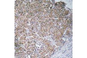 Immunohistochemical analysis of CHST13 staining in human liver cancer formalin fixed paraffin embedded tissue section. (CHST13 抗体)