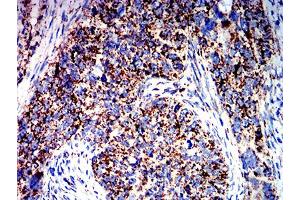 Immunohistochemical analysis of paraffin-embedded cervical cancer tissues using ATPIF1 mouse mAb with DAB staining. (ATPase Inhibitory Factor 1 抗体  (AA 1-106))