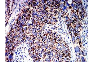 Immunohistochemical analysis of paraffin-embedded cervical cancer tissues using ATPIF1 mouse mAb with DAB staining.
