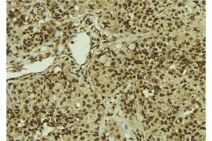 ABIN6279887 at 1/100 staining Human breast cancer tissue by IHC-P. (SART1 抗体  (C-Term))