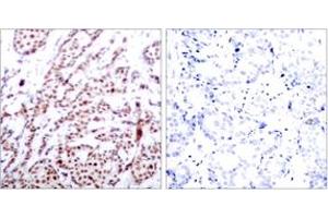 Immunohistochemistry analysis of paraffin-embedded human breast carcinoma, using ATF2 (Phospho-Thr73 or 55) Antibody. (ATF2 抗体  (pThr73))