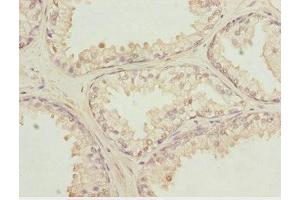 Immunohistochemistry of paraffin-embedded human prostate cancer using ABIN7156132 at dilution of 1:100 (KPNA6 抗体  (AA 277-536))