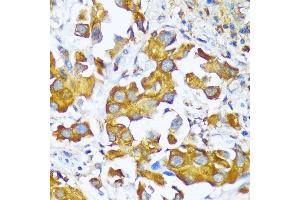 Immunohistochemistry of paraffin-embedded human lung cancer using AARS antibody (ABIN7265526) at dilution of 1:100 (40x lens). (AARS 抗体  (AA 1-100))