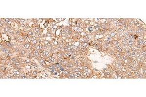 Immunohistochemistry of paraffin-embedded Human liver cancer tissue using SIGLECL1 Polyclonal Antibody at dilution of 1:65(x200) (SIGLECL1 抗体)