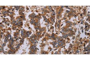 Immunohistochemistry of paraffin-embedded Human liver cancer using GDF2 Polyclonal Antibody at dilution of 1:40 (GDF2 抗体)