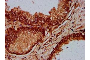 IHC image of ABIN7151584 diluted at 1:600 and staining in paraffin-embedded human prostate cancer performed on a Leica BondTM system. (ELP4 抗体  (AA 117-223))