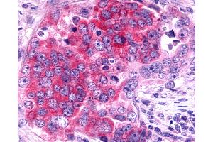 Anti-TAAR6 antibody IHC of human Ovary, Carcinoma. (TAAR6 抗体  (Cytoplasmic Domain))