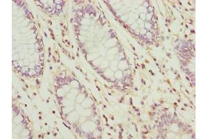 Immunohistochemistry of paraffin-embedded human colon cancer using ABIN7174542 at dilution of 1:100 (UBL3 抗体  (AA 17-114))