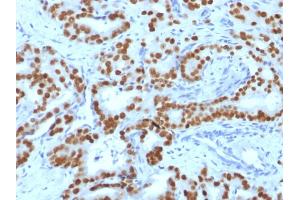 Formalin-fixed, paraffin-embedded human Prostate Carcinoma stained with FOXA1 Monoclonal Antibody (FOXA1/1519). (FOXA1 抗体  (AA 372-472))