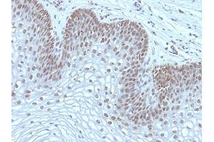 Formalin-fixed, paraffin-embedded human Cervical Carcinoma stained with MAP3K1 Mouse Monoclonal Antibody (2F6). (MAP3K1 抗体  (AA 1077-1176))