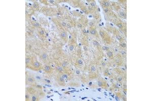 Immunohistochemistry of paraffin-embedded human liver cancer using Furin antibody (ABIN6127933, ABIN6140815, ABIN6140817 and ABIN6223322) at dilution of 1:100 (40x lens). (FURIN 抗体  (AA 120-370))
